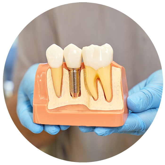 All-On-Four-Dental-Implants